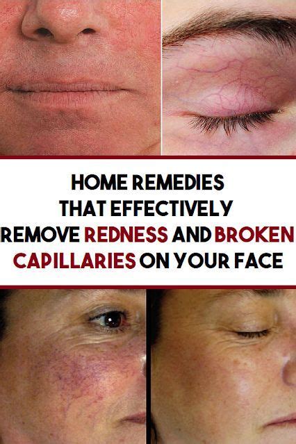 Lets Talk About Broken Capillaries And How To Get Rid Of Them Fast