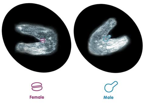 When Can Ultrasound Detect Gender 🌈cf Liver Disease And The Role Of
