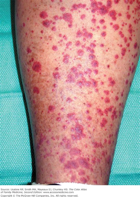 Necrotizing Vasculitis Pictures