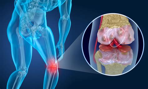 Safety Of Stem Cell Therapy For Chronic Knee Pain Confirmed In New Study