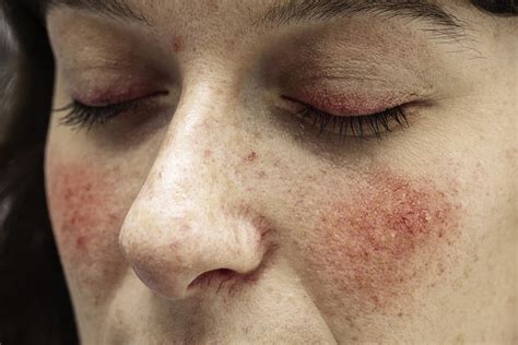 Rosacea Treatment Melbourne Rosacea Treatments At Our Clinic Spot