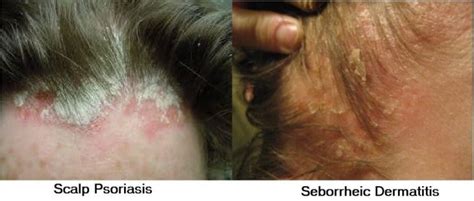 تفاوت درماتیت سبوره و پسوریازیس درمان درماتیت سبوره پوست پدیا