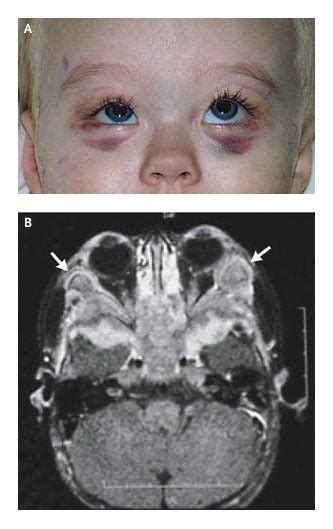 Raccoon Eyes And Neuroblastoma Nejm