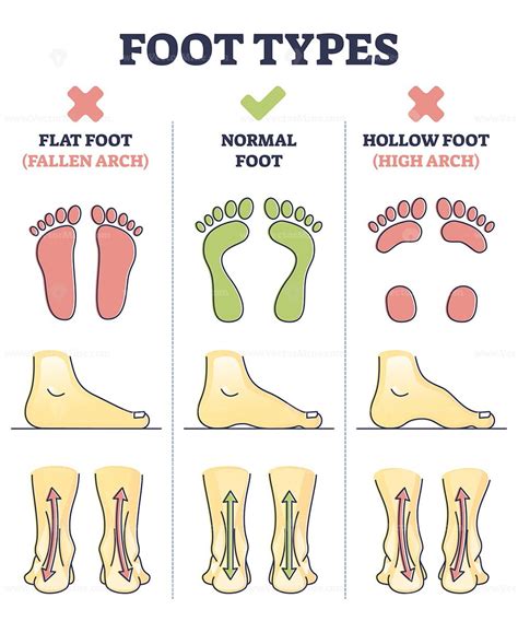 Foot Types With Flat Normal And Hollow Feet Comparison In Outline