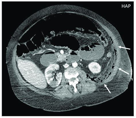 Ct Appearance Of Necrotizing Fasciitis In A 58 Year Old Woman With A