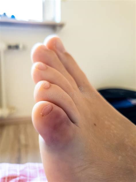 √100以上 How Do I Know If My Pinky Toe Is Broken Or Just