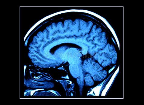 Photo About Mri Scan Of A Human Brain Image Of Hypothalamus Human