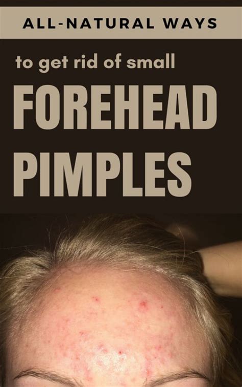 How To Get Rid Of Pimples On Forehead Fast At Home Pimples On