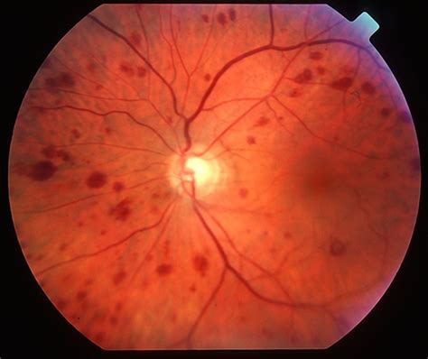 Ocular Ischaemic Syndrome Colour 1 Retina Image Bank