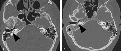 Computed Tomography Ct Imaging Of Adenomatous Neuroendocrine Tumors