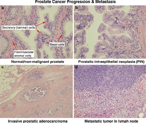 Histopathology Of The Human Prostate Cancer Progression A