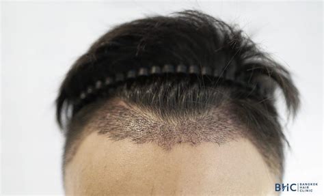 Aggregate 80 Hair Transplant Complications Latest In Eteachers