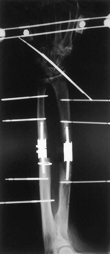 Anteroposterior Radiograph Of The Forearm Showing The Metal Implants