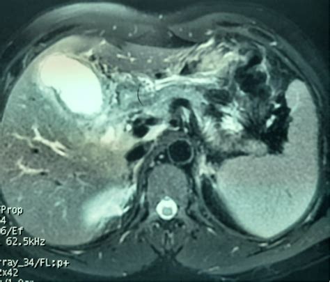 Figure 2 From Tuberculosis Or Gallbladder Carcinoma A Confusing