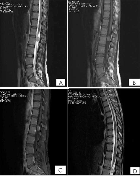 Sagittal T And T Weighted Image Of Lumbar And Thoracic Spine A