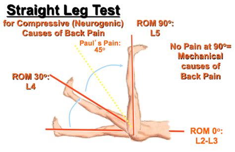 Braggard's test) is used to evaluate whether lumbar and/or ischiadic pain originates from lumbosacral radiculopathy (e.g. straight leg raising test - DNB Orthopaedics MS Orthopedics MRCS Exam GUIDE - Orthodnb.com