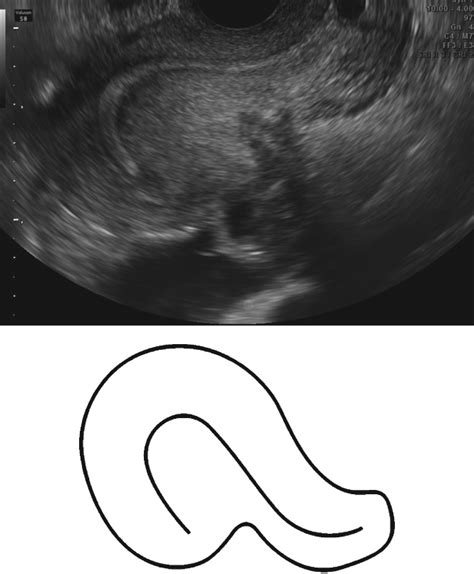 Question Mark Form Of Uterus A Simple Sonographic Sign Associated With