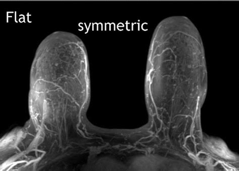 An Analysis Of Nipple Enhancement At Breast Mri With Radiologic