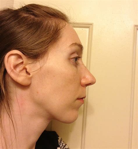 Beckys Upper Jaw Surgery Blog Final Thoughts