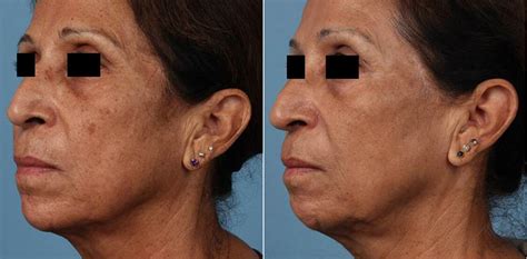 We did not find results for: Pigmentation - Edmonton Tattoo Removal | Laser Hair ...