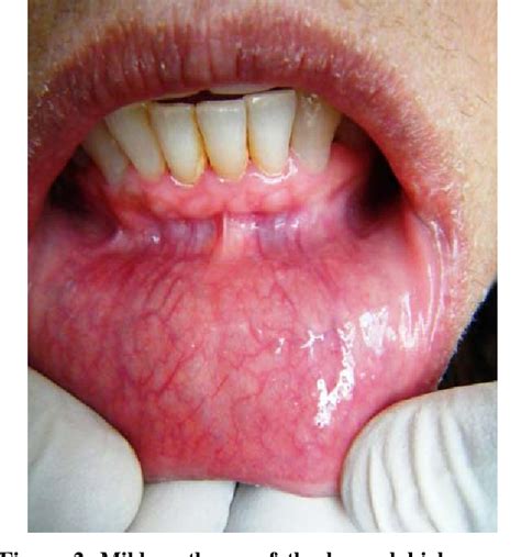 Figure 2 From Burning Mouth Syndrome Due To Television Moans An Enigma