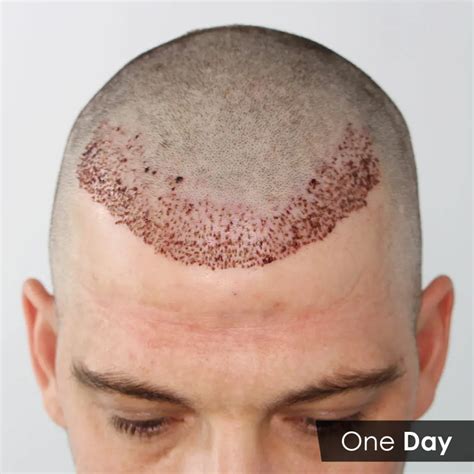How Long Is The Recovery Time For Hair Transplant Cosmetic Surgery Tips