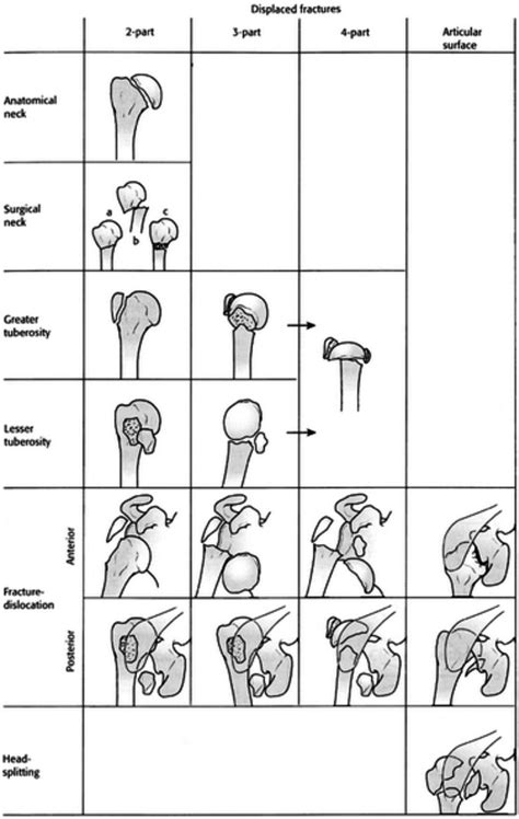 Neer Classification Download Scientific Diagram