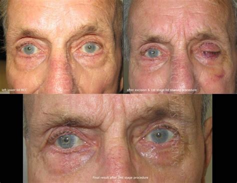 Eyelid Facial Skin Cancer Treatments Eyelid Surgery Ophthalmic Plastic