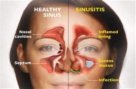 Kill Sinus Infection In Seconds With This Simple Method And This Common Household Ingr