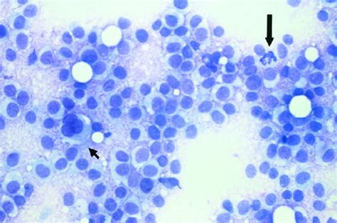 Cytology Of Myoepithelial Carcinoma Of The Salivary Gland Chhieng