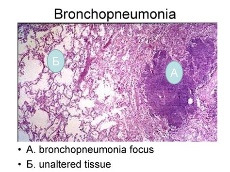 Acute Pneumonia Bronchopneumonia Croupous Interstitial