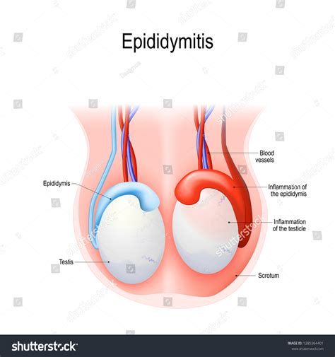 Epididymitis Inflammation Epididymis Testicle Illustration Adult Ilustrações Stock 1285364401