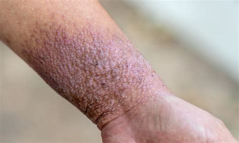Quoi De Neuf Dans La Dermatite Atopique Réalités Thérapeutiques En
