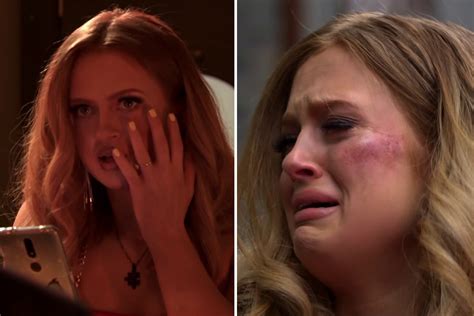 Eastenders Fans Disturbed As Tiffany Butcher Bakers Face Swells Up