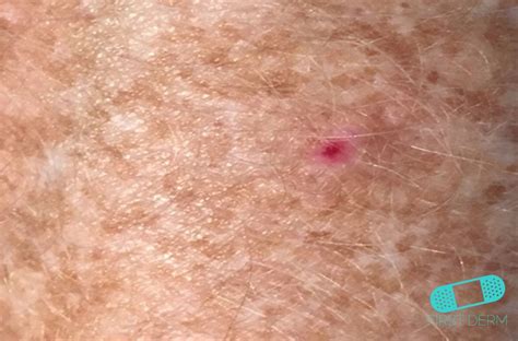 Online Dermatology Basal Cell Carcinoma Basal Cell Skin Cancer Bcc