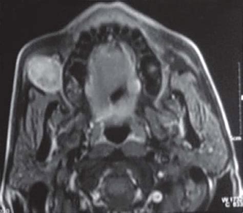 T1 Weighted Fat Suppression Image Postcontrast Inhomogenous