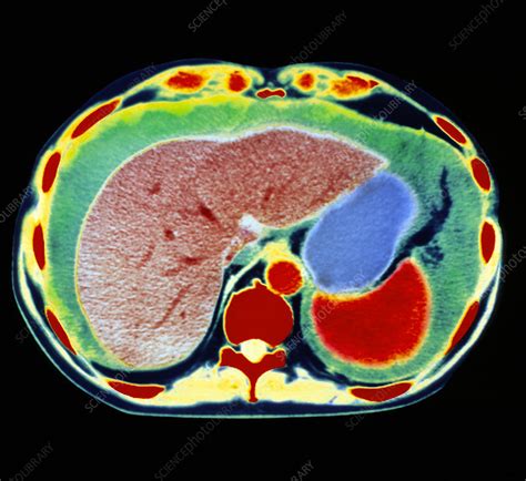 Coloured Ct Scan Showing Ascites Of The Abdomen Stock Image M108