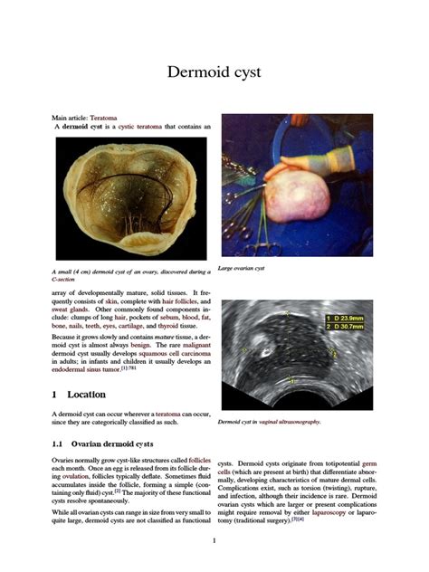 Dermoid Cyst Pdf Medicine Diseases And Disorders