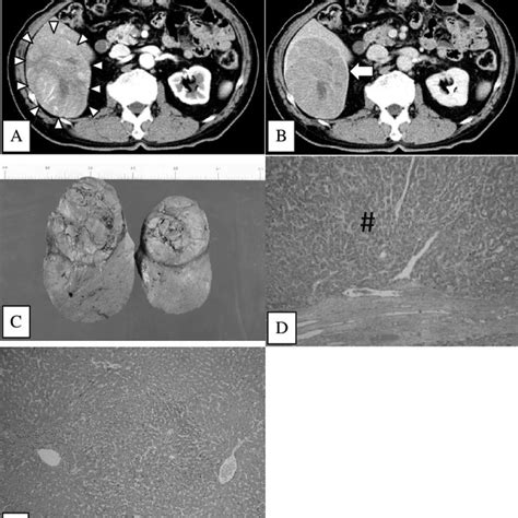 A And B Contrast Enhanced Ct Showed Enhancement Of The Tumor In The