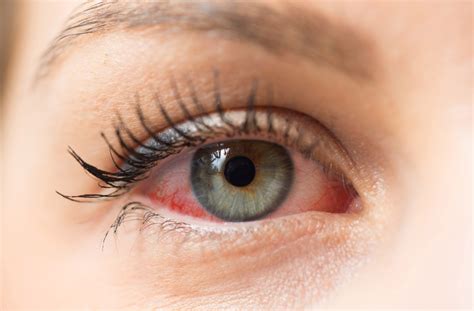 10 Causes And Treatments For Eye Redness Niagara Falls On