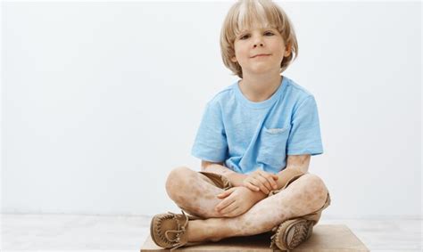 5 Ways Parents Can Support Their Kids Through A Vitiligo Diagnosis