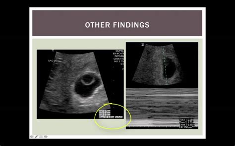 Critical Decisions With 1st Trimester Pregnancy Ultrasound Part 1
