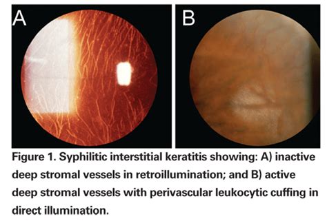How To Recognize Ocular Syphilis