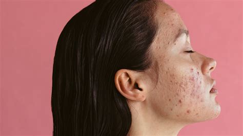 Tips For Reducing Redness From Acne