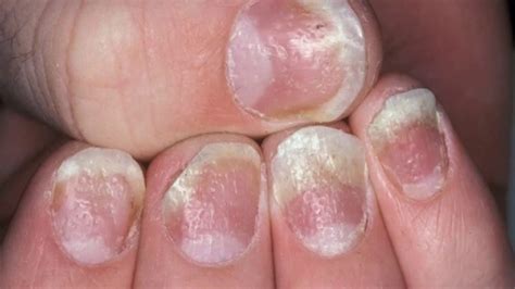 Home Remedies For Nail Psoriasis Youtube