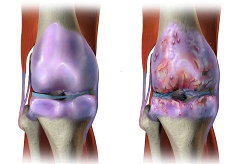 Knee Osteoarthritis In Early Rheumatoid Arthritis May Affect Disease