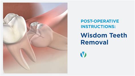 Post Operative Instructions Wisdom Teeth Removal Greater Ventura