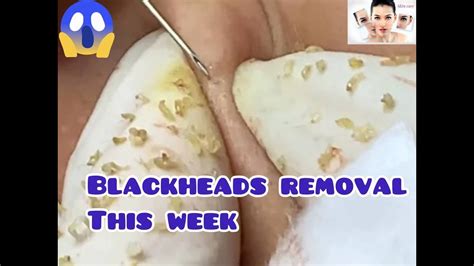 Blackheads Remove This Week Acne Extraction Pimple Popping Youtube