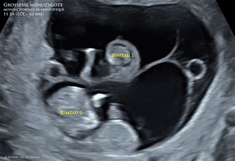 Grossesse G Mellaire Monozygote Monochoriale Biamniotique Sa