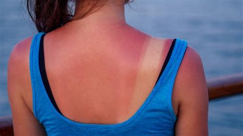Ouch How To Treat That Nasty Sunburn Cbc News